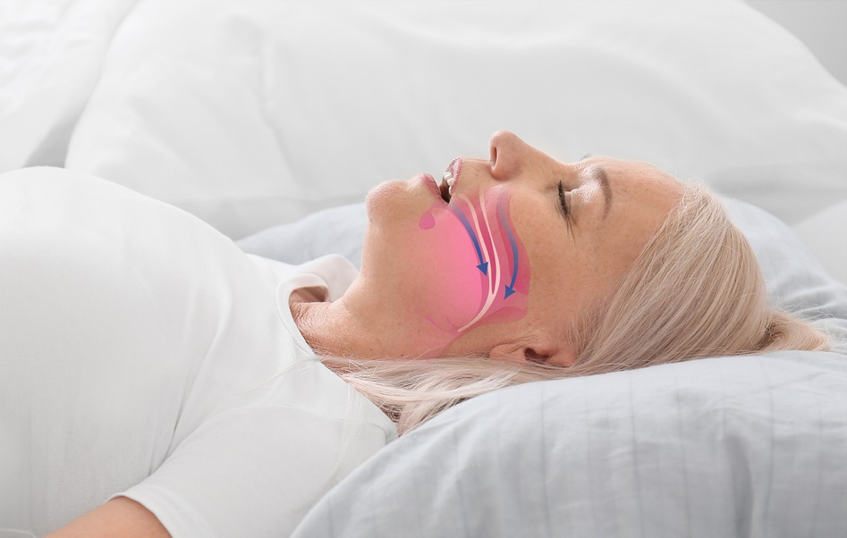 Obstructive Sleep Apnea: Causes, Symptoms, and Treatments